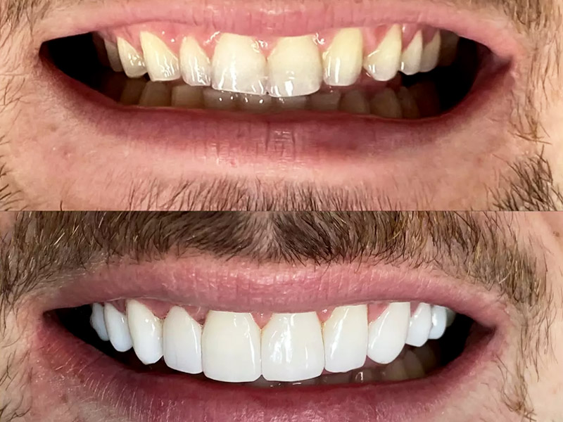 Facetas de resina composta em Campinas/SP Facetas de resina composta em Campinas/SP