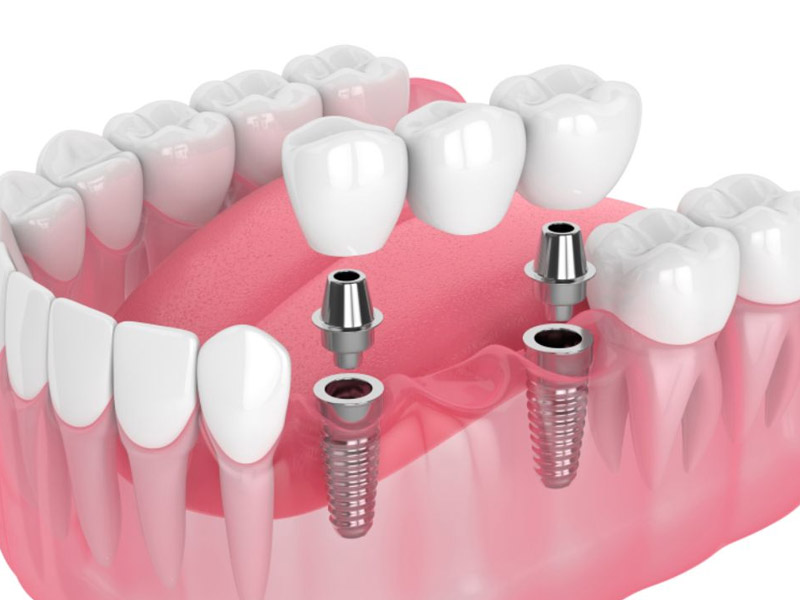 Implantes dentários em Campinas/SP