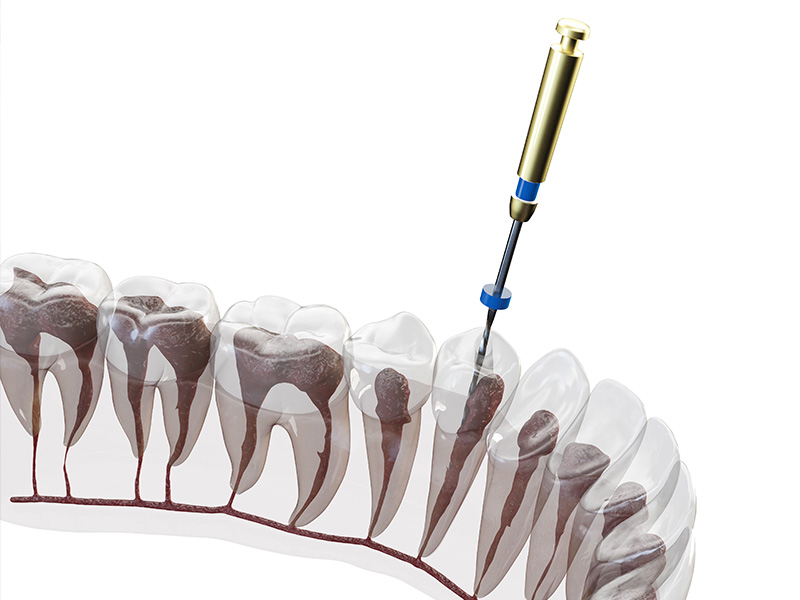 Preço do canal no dente em Sorocaba/SP